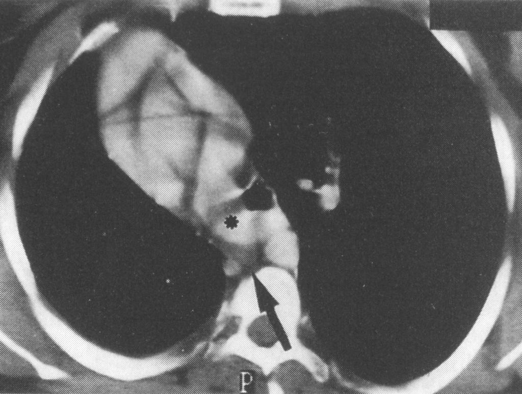 Fig. 37: Desplazamiento mediastínico a la derecha por hipoplasia pulmonar.