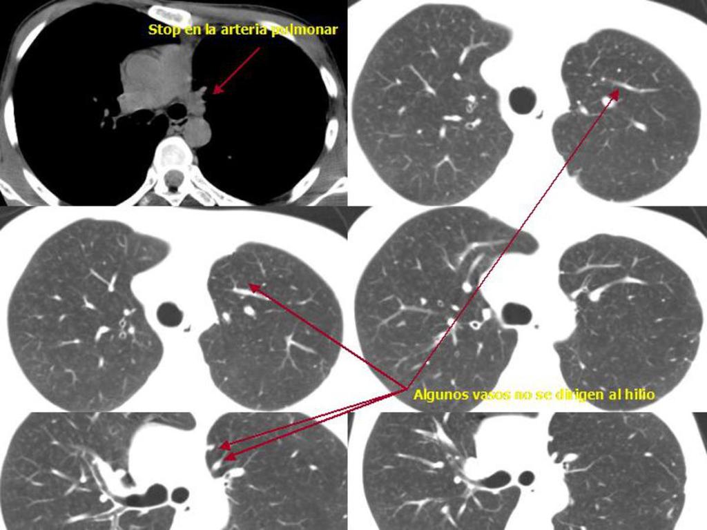 Fig. 40: TC en ventana de mediastino y pulmón demostrando stop brusco en arteria pulmonar I
