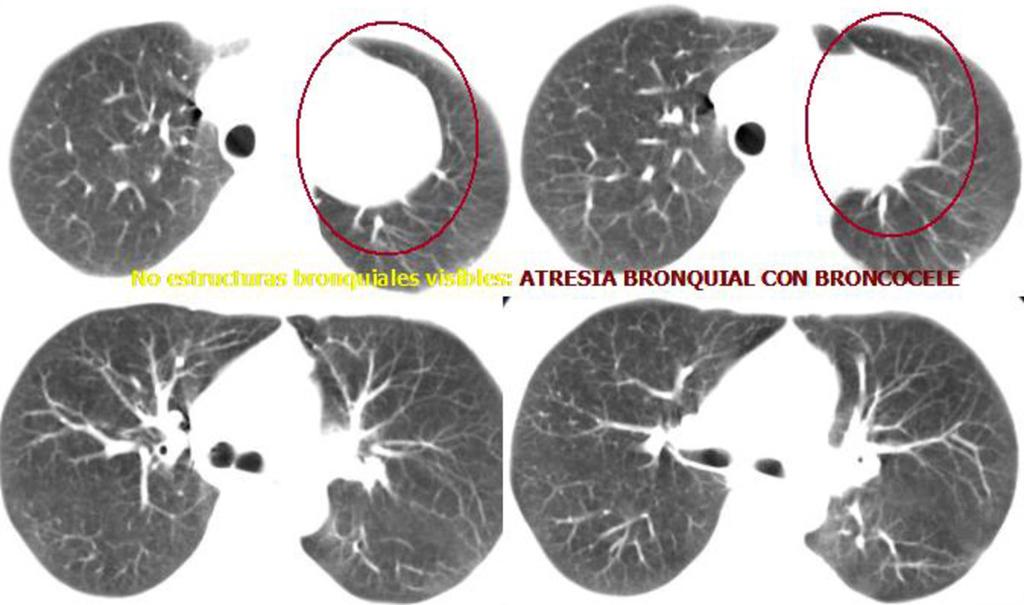 Fig. 47: TC de tórax en paciente con atresia bronquial con broncocele mostrado en Fig.