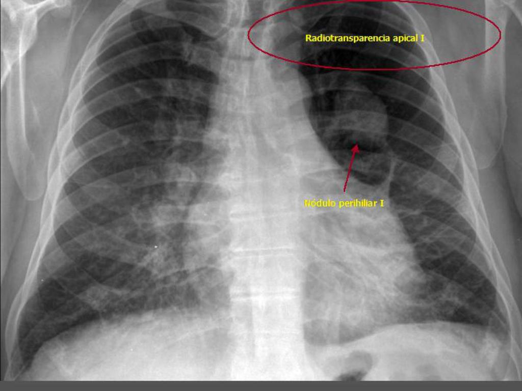 Fig. 49: Proyección posteroanterior de tórax con atresia bronquial
