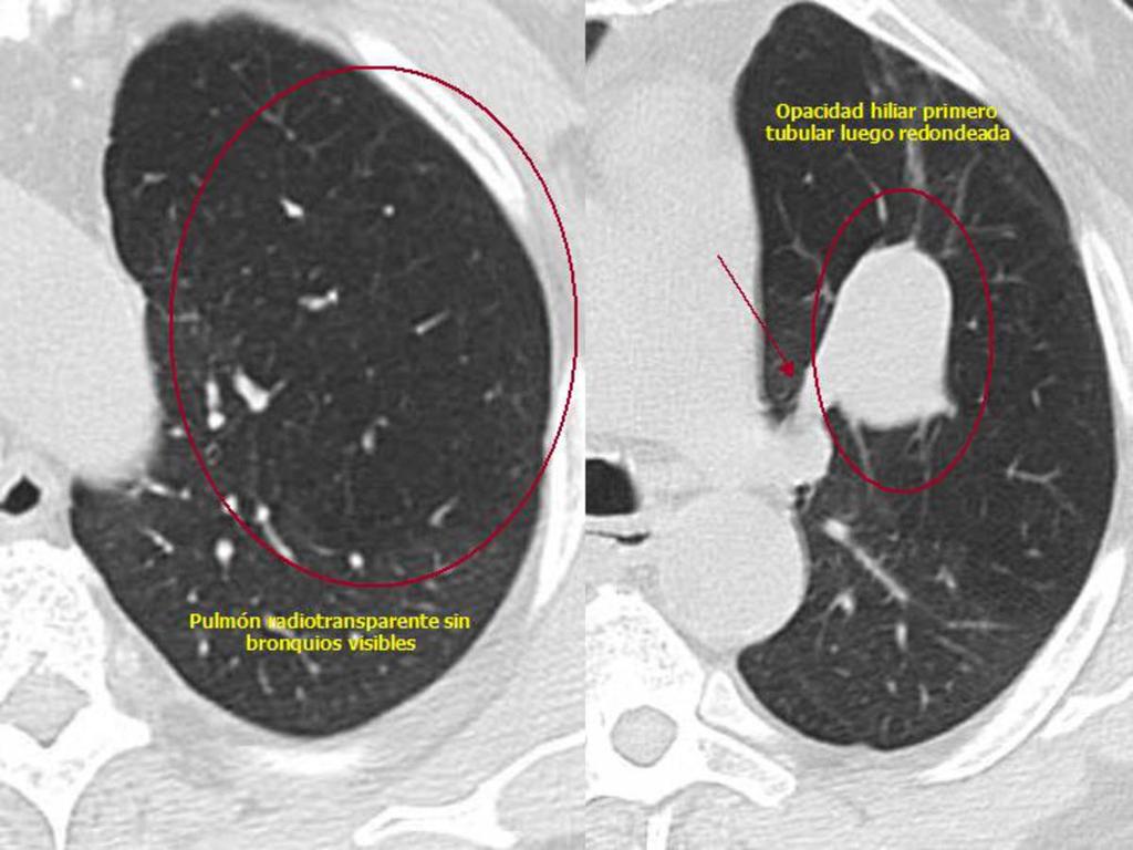 Fig. 50: TC con ventana de pulmón del mismo paciente mostrado en Fig.
