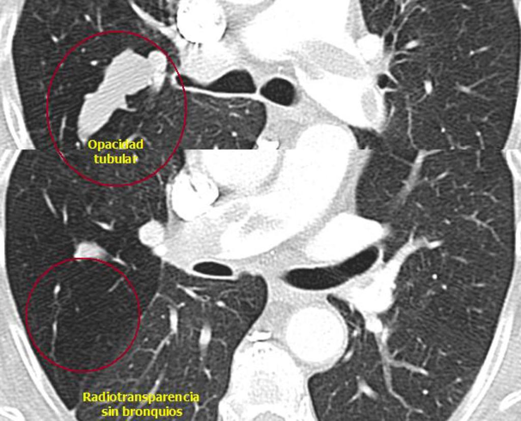 Fig. 52: La visualización de la arteria segmentaria adyacente a la opacidad tubular, la ausencia de estructuras bronquiales en el
