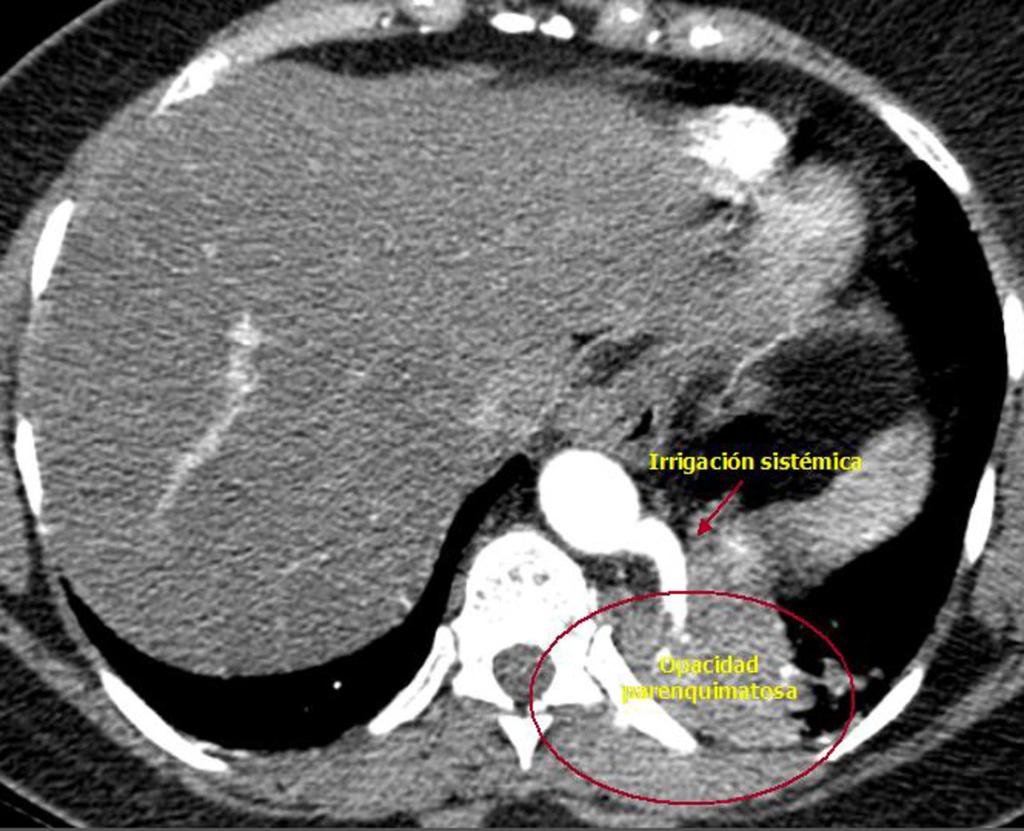 Fig. 58: TC del mismo paciente que demuestra vaso nutricio dependiente de la aorta en