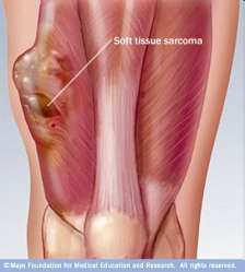 conocidos) Sarcoma: células de tejido conectivo