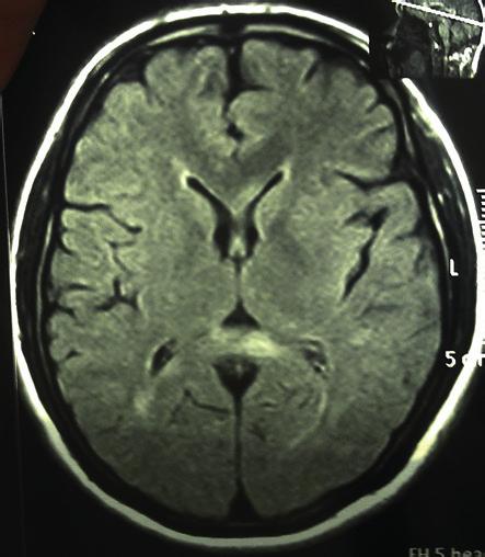 98 Case report Introduction is characterized by demyelination of the corpus callosum.