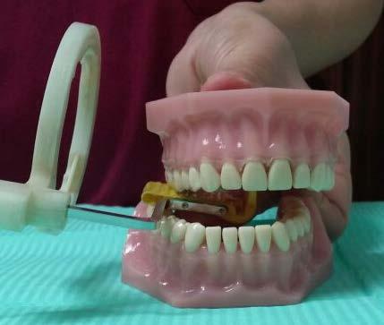 Indicale al paciente que cierre la boca, para que con sus dientes lo mantenga firme y en la posición