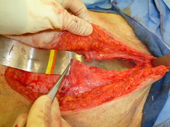 Figura 16: Preparación para la sutura de los bordes de la vaina del musculo recto abdominal Figura 18: Piel suturada y drenaje aspirativo Cuidados