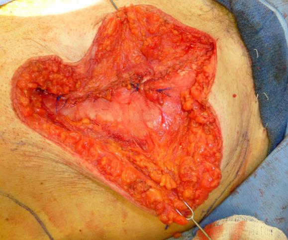 probablemente suficientemente resistente, los restos de la vaina anterior del músculo a nivel del colgajo también se aproximan con sutura no