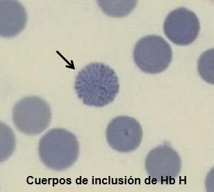 SERIE ROJA Hematíes 7.02 10E6/μL Hemoglobina 9.1 g/dl Hematocrito 27.2 % V.C.M. 46.5 fl H.C.M. 13.2 pg C.H.C.M. 27.9 g/dl A.D.E. 27.4 % Reticulocitos 4.