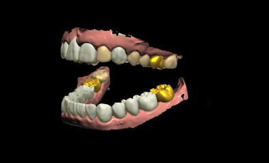 Bienvenido al lanzamiento de la versión 2010n de Dental System de 3Shape!