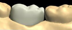 El mirroring virtual de los dientes diseñados y existentes permite alcanzar rápidamente una simetría perfecta.