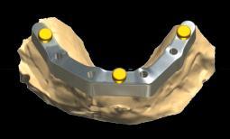 Coronas de alta calidad retenidas por tornillos (opcional) Dental System 2010 garantiza un flujo de trabajo rápido, cuidadoso y fácil de usar para la producción de restauraciones unitarias