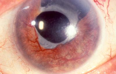 ISQUEMIA RETINAL GLAUCOMA NEOVASCULAR Hipoxia