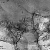 angiografía cerebrofacial, de posible Hemangiopericitoma. 3 Fig.1 y 2.RNM T2 corte axial. 1 2 Fig. 4. y 5.