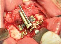 Se le practica reducción de fractura parasinfisaria izquierda con colocación de 2 miniplacas de titanio, ferulización de ambas