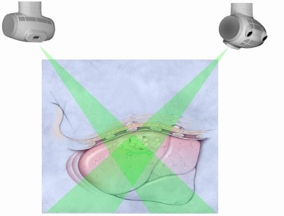 SYNCHRONY Correlación entre la oscilación de los marcadores de fibra óptica y la ubicación del target en las imágenes en vivo El modelo respiratorio refleja