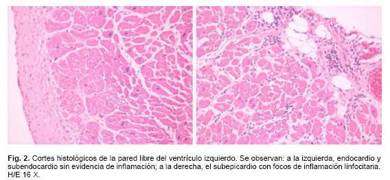 La fisiopatogenia de la miocardiopatia chagásica crónica es multifactorial Infección crónica por T.