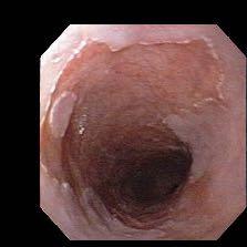 Esófago de Barrett - El epitelio escamoso esofágico es sustituido por mucosa de aspecto gástrico (epitelio columnar) y en la