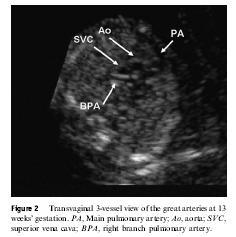 Malformaciones cardiacas Ecocardiografía fetal del primer trimestre indicada en