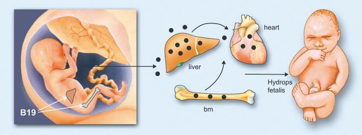 Parvovirus B19: Infección durante el embarazo Vertical transmission of B19 from a primary infected mother may cause foetal infection.