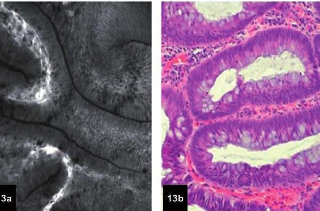 a) Mucosa colónica normal visualizada con endoscopia confocal; b) Mucosa colónica normal visualizada con microscopía óptica.
