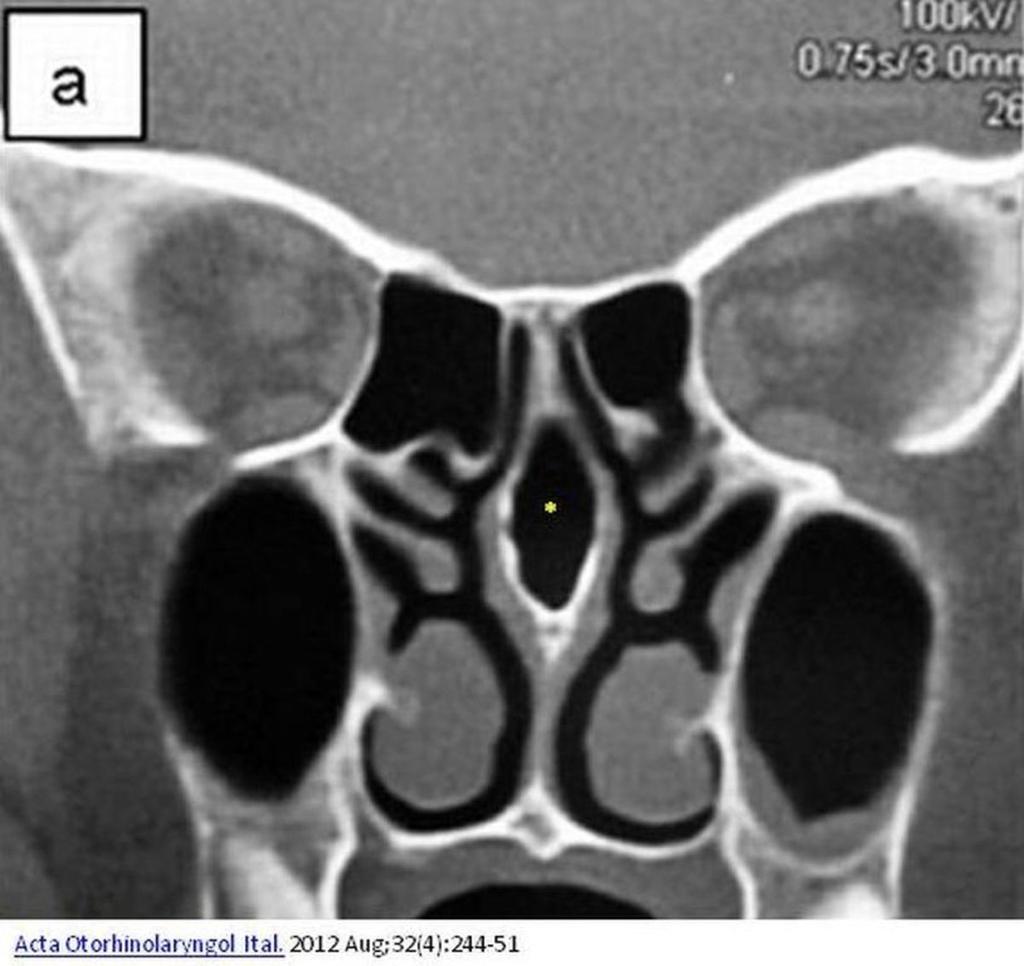 Fig. 12: Neumatización del septo nasal(*). Corte coronal TC. Referencias: http://radiologiaroclapy.blogspot.com.