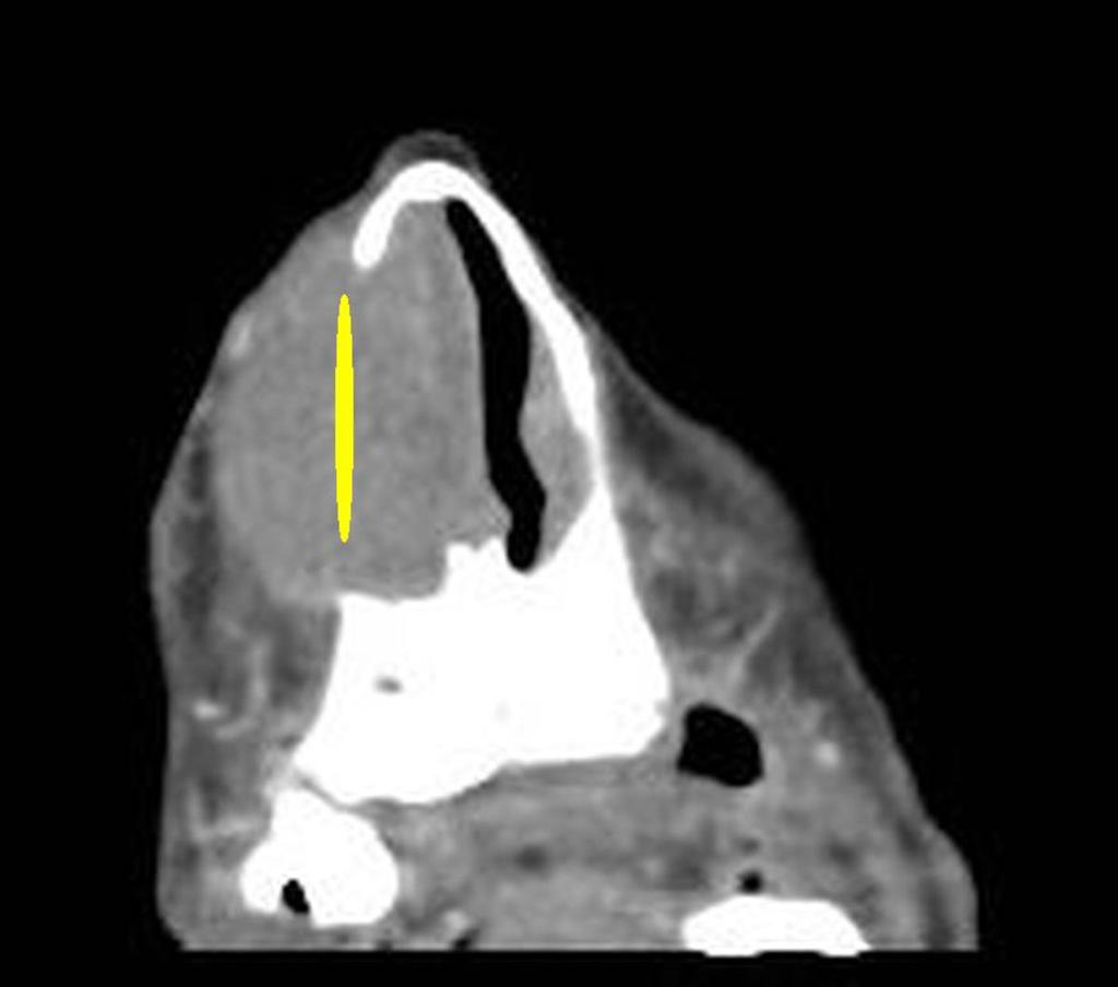 Afectación ósea La RMN es más sensible para detectar afectación de la médula ósea, mientras el TC muestra sutiles erosiones.