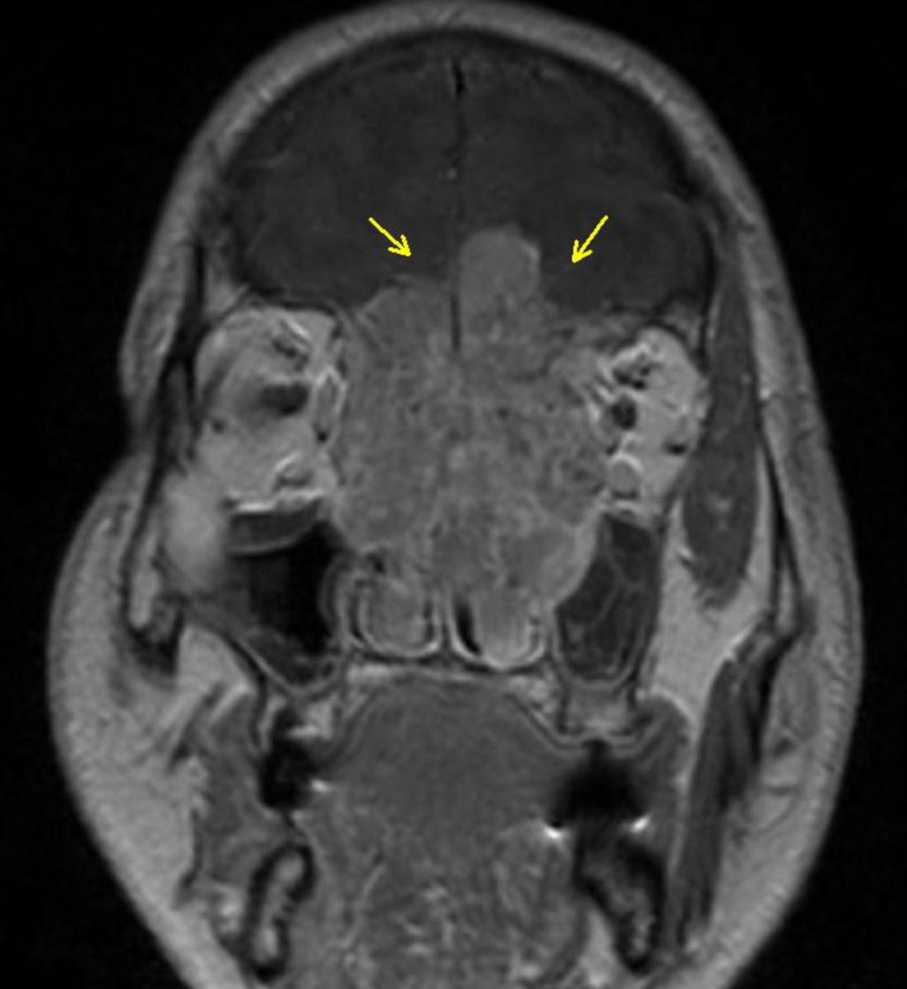 Las neoplasias sinusales que mas frecuentemente erosionan e invaden la base del craneo son los carcinomas indiferenciados, los estesioneuroblastoma y los sarcomas. Fig.