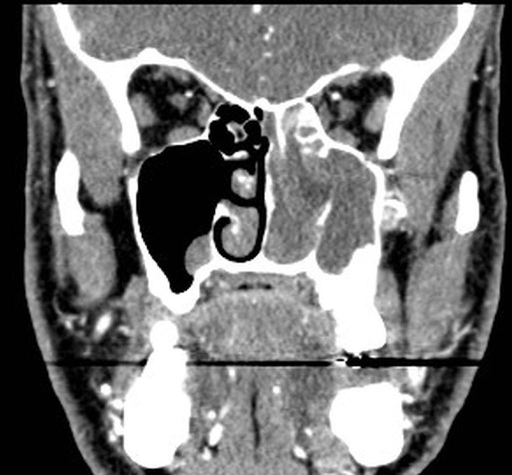 Fig. 48: Adenocarcinoma intestinal de la nariz.plano coronal TC postcontraste. Ocupación de la fosa nasal izquierda por masa con captación heterogenea que parece depender del cornete medio.