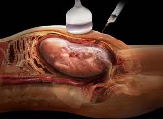 Terapia Fetal Invasiva: Cirugía