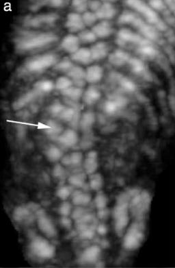 representación del volumen se puede usar para demostrar las lesiones cutáneas de la espina bífida abierta y la posible presencia de un