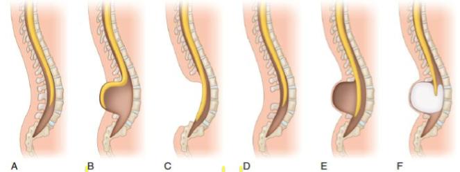 Disrafía Espinal o espina Bífida Paladini D, Volpe P.