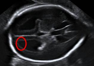 Espina Bífida Abierta La ventriculomegalia aparece en el 70-90% de fetos con defectos de tubo neural abiertos Puede ser