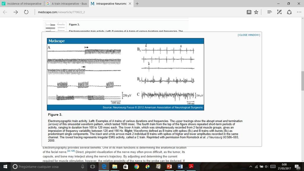 EMG barrido libre Tipo A: Semejantes a descargas neurotónicas (100-500 μv de amplitud, inicio y fin brusco, frecuencia 60 210 Hz, de ms a s).