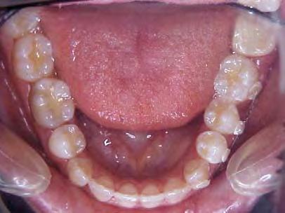 La mesialización de molares para sustitución de piezas faltantes es un método