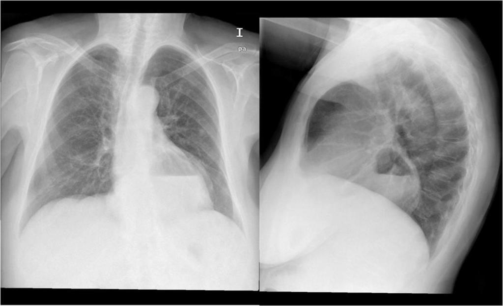 Fig. 15: Hernia de hiato (TC con contraste oral e intravenoso)