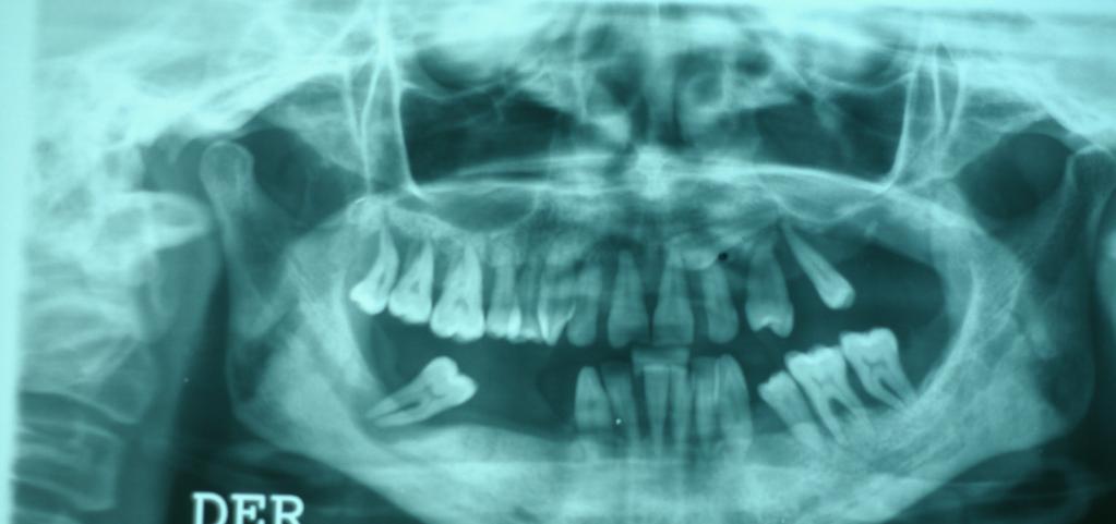 1º caso: rehabilitación oral sobre implantes: 8 implantes en maxilar superior y 10 implantes en maxilar inferior. En la figura 3.