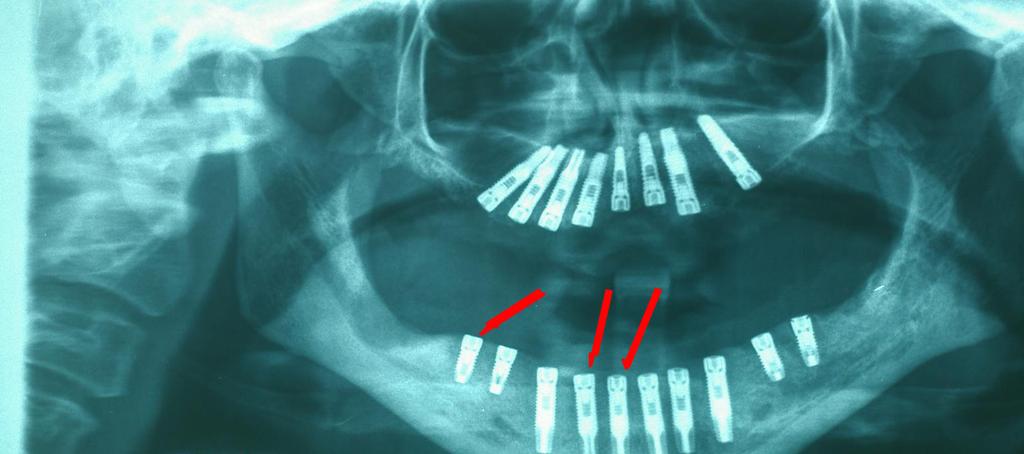 maxilar superior, con un hueso remanente muy critico y en posición lógicamente muy inclinada: Los implantes están en el espacio entre los senos maxilares sin invadir a estos.