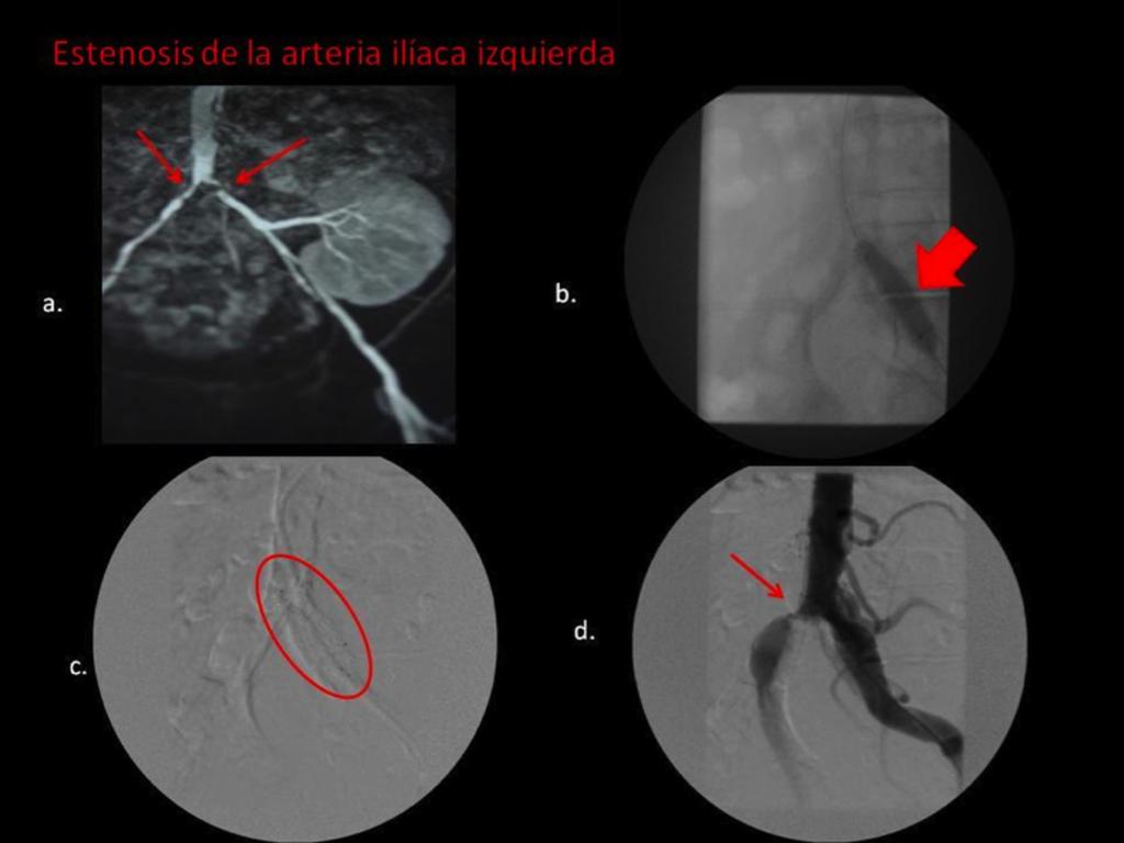 Fig. 19: Estenosis de la arteria ilíaca: Paciente 3 veces trasplantado renal con altos niveles de creatinina sérica e HTA incontrolable. Se sospechaba EAR pero se descartó en dos estudios ecográficos.