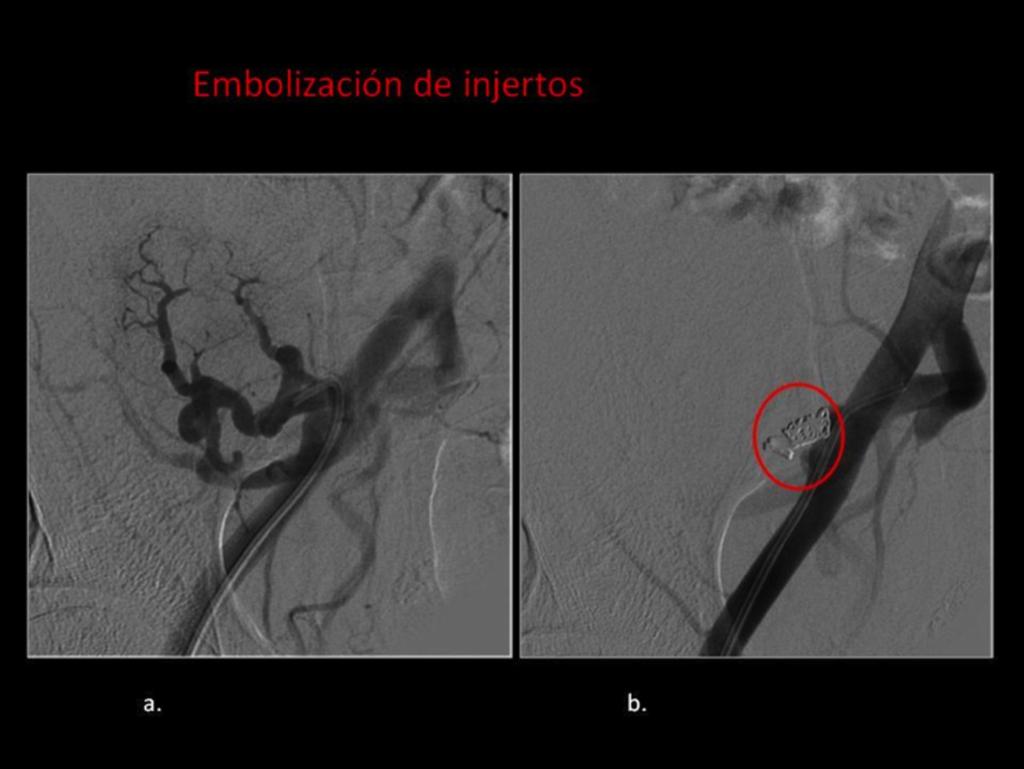 Fig. 20: Embolización de injertos. (A) Imagen de angiografía con cateterización selectiva de la arteria renal. Se realizó embolización de arteria distales con esferas.