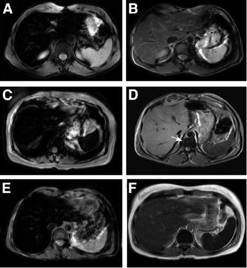 MRI scans from patients with hemochromatosis and other iron-loading disorders A 50-year-old male with HFE hemochromatosis before and after phlebotomy, respectively.
