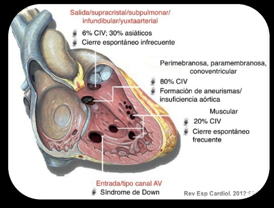 SHUNT IZQ- DERECHA COMUNICACIÓN INTERVENTRICULAR Defecto aislado más común y componente de muchas cardiopatías congénitas Clasificación en función de la PARTE AFECTA (membranosa, perimembranosa,