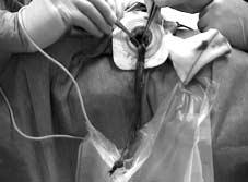 Figura 2. Se resecaron 27 centímetros en este paciente por vía totalmente transanal. de su síndrome de hipoventilación central.