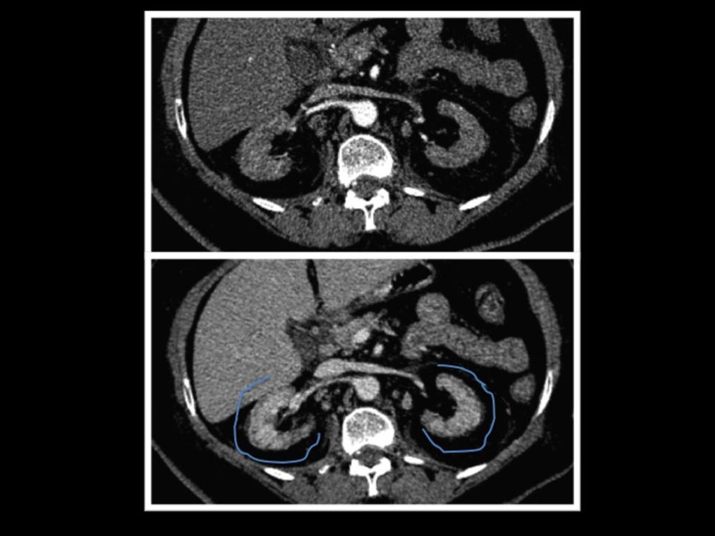 Fig. 14: Defecto fino del nefrograma en la totalidad de la periferia de ambos riñones visto en la imagen inferior sugerente de