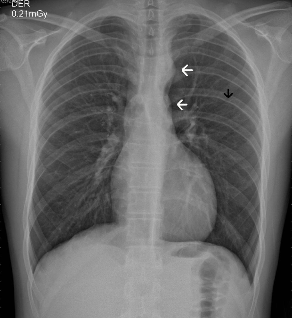 Coartación Aórtica Figura 1. Radiografía de tórax.