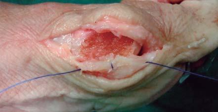 por la articulación y distalmente a un centímetro de la misma, dirigiendo la sutura hacia el trayecto de la cápsula dorsal, llevándola de distal a proximal y dejando distalmente un huso de