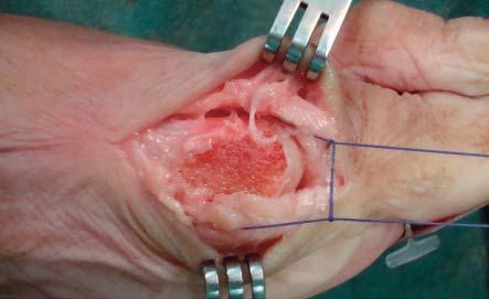 (Izquierda) Imagen clínica dorsoplantar de la deformidad de hallux valgus con el segundo dedo supraducto. (Derecha arriba) Deformidad, vista lateral.