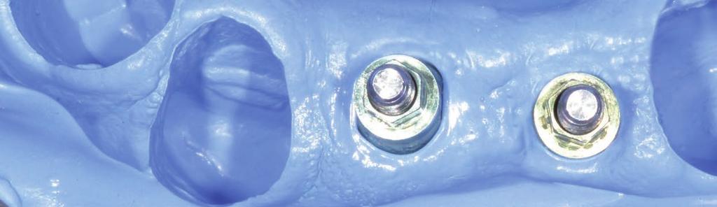 7. Impresión con Hydrorise Implant
