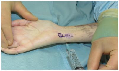 paciente despierto con la inserción de la aguja debe impulsar la retirada de la aguja, ya que puede indicar que la aguja esta intraneural.