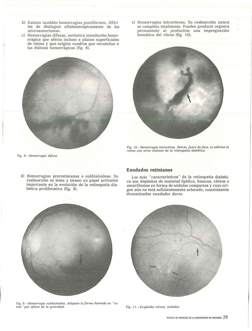 b) Existen también hemorragias puntiformes, difíciles de distinguir oftalmoscópicamente de los microaneurismas.
